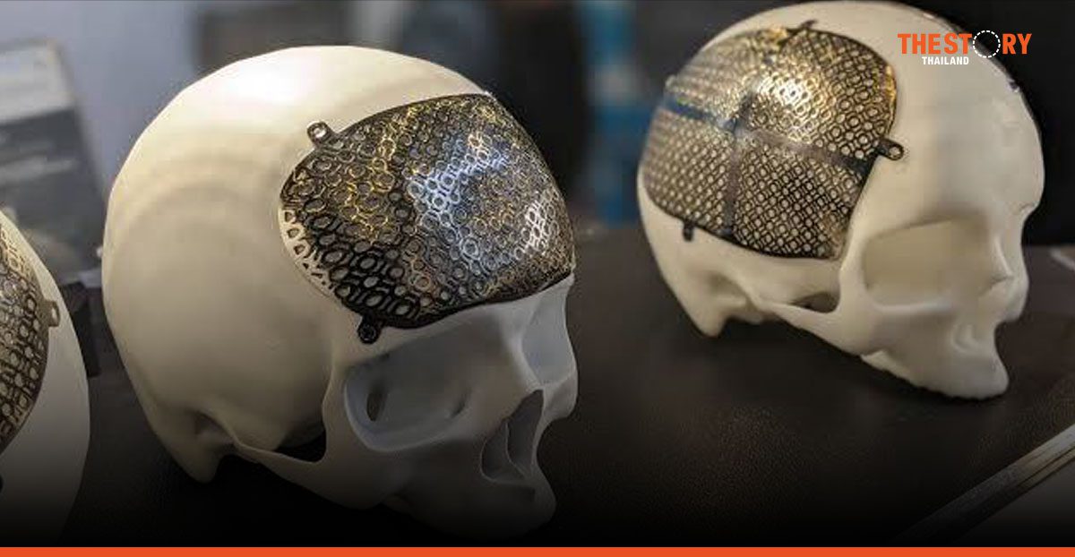 TCELS ติดตามผลการใช้ “แผ่นปิดกะโหลกไทเทเนียม” ในระบบหลักประกันสุขภาพ